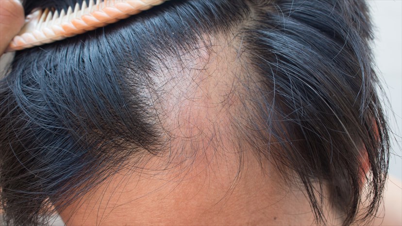 apa itu alopecia areata