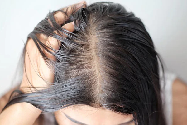 rambut berminyak